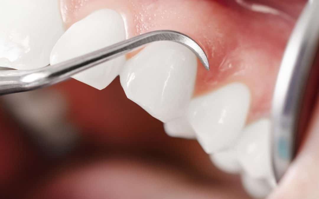 periodontal-treatment-1080x675